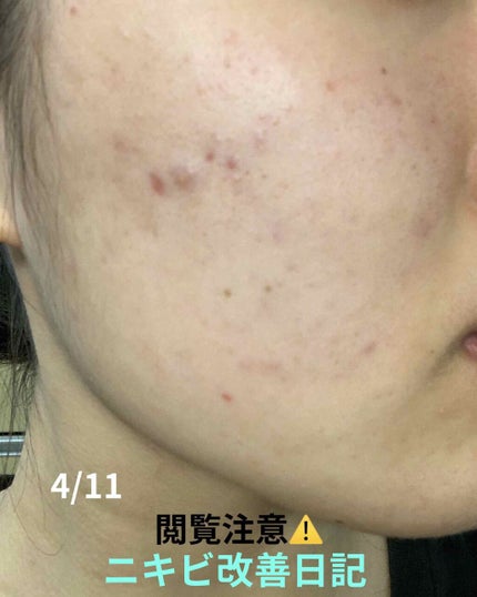薬用 しみ 集中対策 美容液/メラノCC/美容液を使ったクチコミ(1枚目)