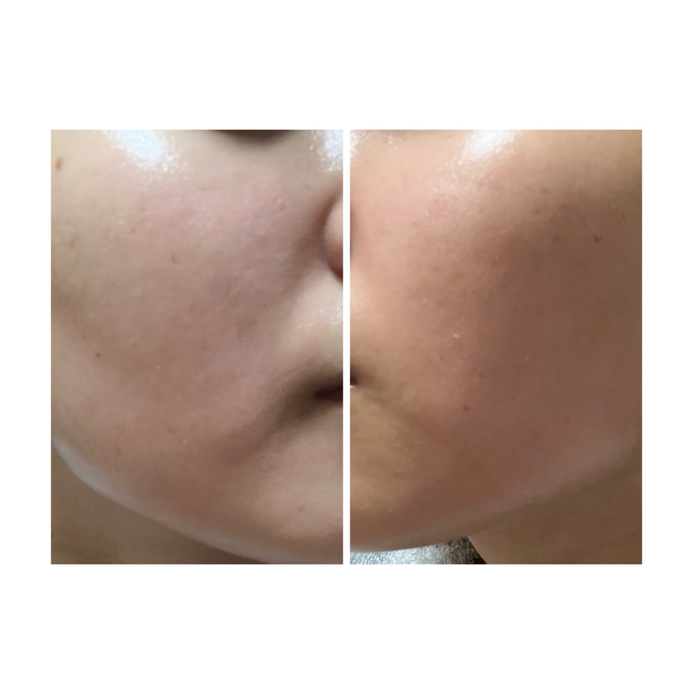 ぽむ on LIPS 「2023.9.13皮膚科に受診 エピデュオとヘパリン処方1枚目..」(3枚目)