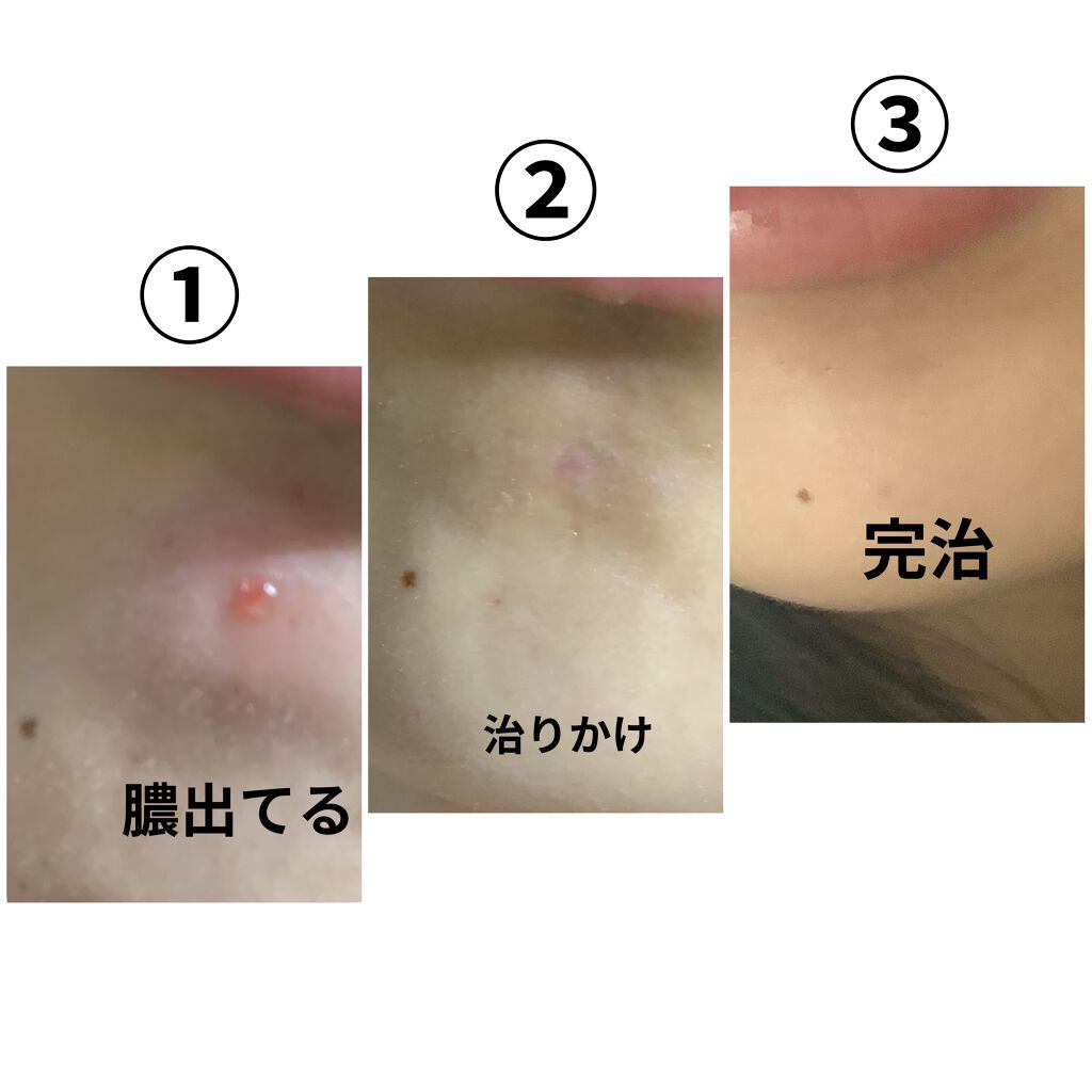 キズパワーパッド/バンドエイド/その他を使ったクチコミ（3枚目）