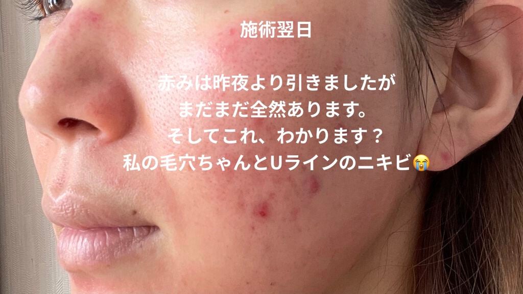 aiko on LIPS 「⚠️写真は真っ赤な肌が出てきます😣今回はコスメではなく、ここ最..」(5枚目)