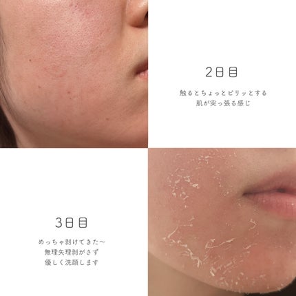 ダーマスキンピーリング/BQCELL/その他キットセットを使ったクチコミ(4枚目)