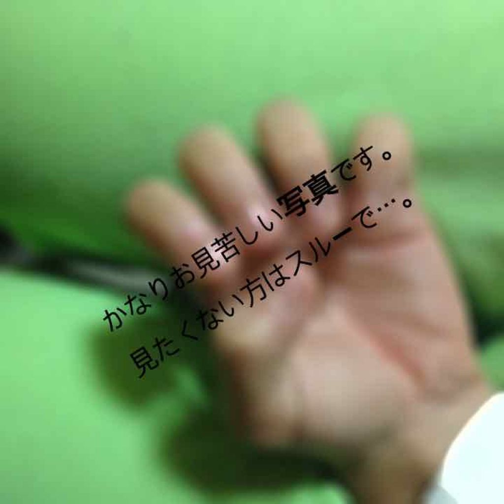 ぽん on LIPS 「綺麗な爪(手)じゃなくてすみません😢😢⚠︎4枚目に深爪の頃の写..」(3枚目)