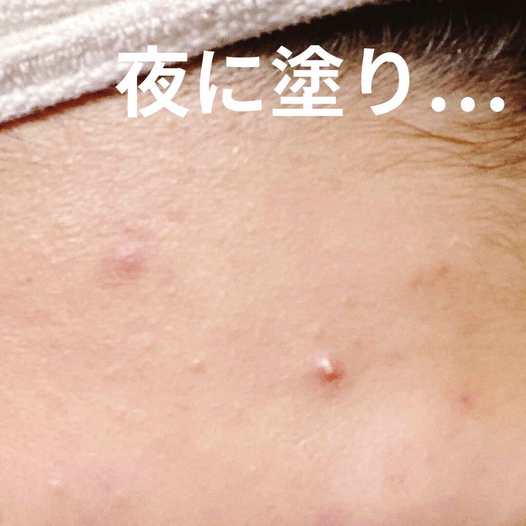 メディカルクリームc(医薬品)/メンソレータム アクネス25/その他を使ったクチコミ(2枚目)