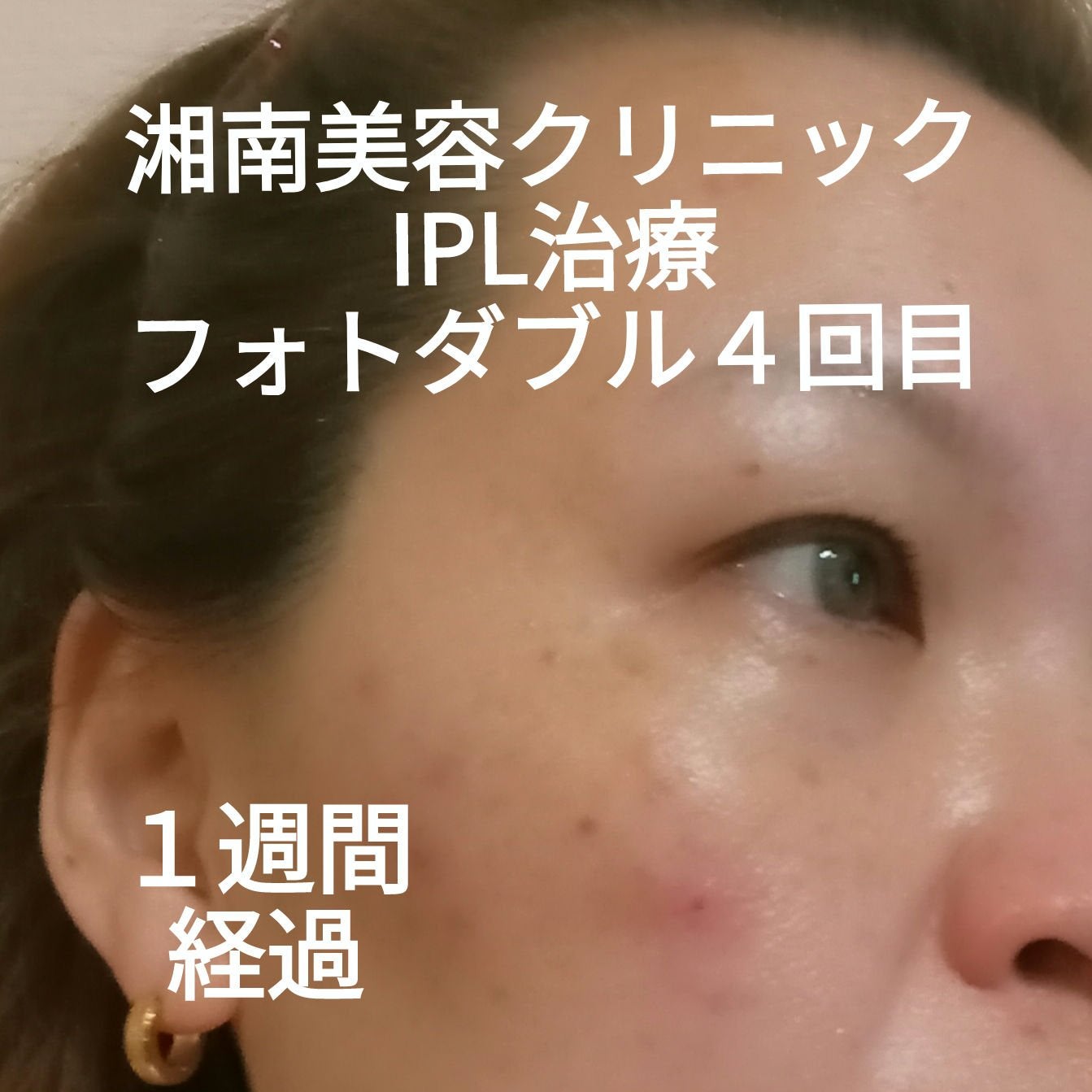 ビヨンセ奥二重向上委員長🥸LIPSパートナー🥳 on LIPS 「湘南美容IPL治療 フォトダブル4回目の1週間経過後の写真です..」(1枚目)