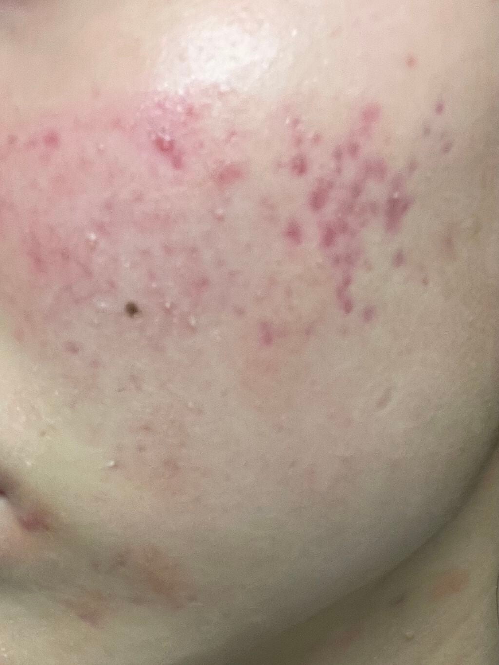 プラス on LIPS 「金曜に皮膚科行ってまたまた青色LED受けてきました〜そして、前..」(1枚目)