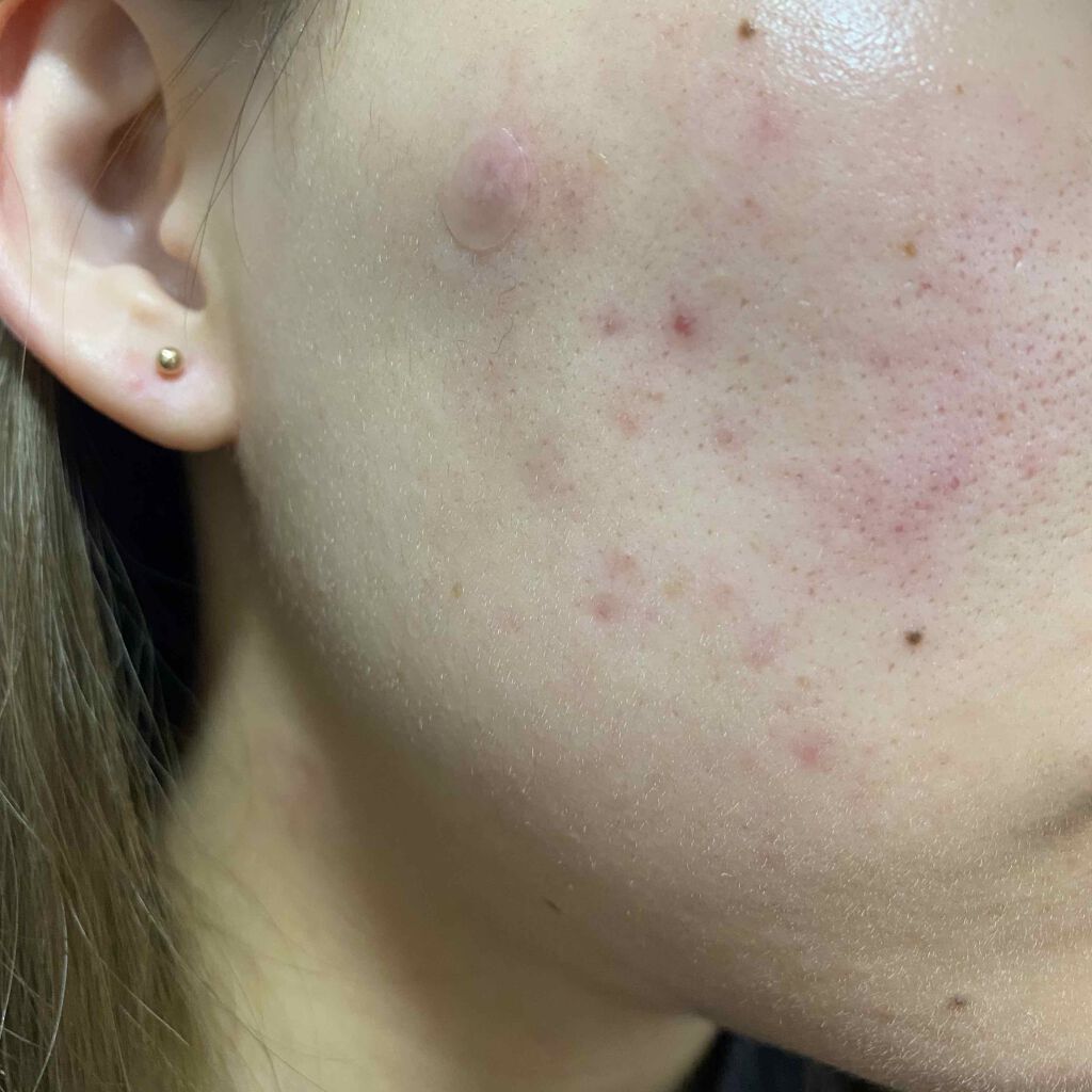 ゼビアックス(医薬品)/マルホ株式会社/その他を使ったクチコミ（2枚目）