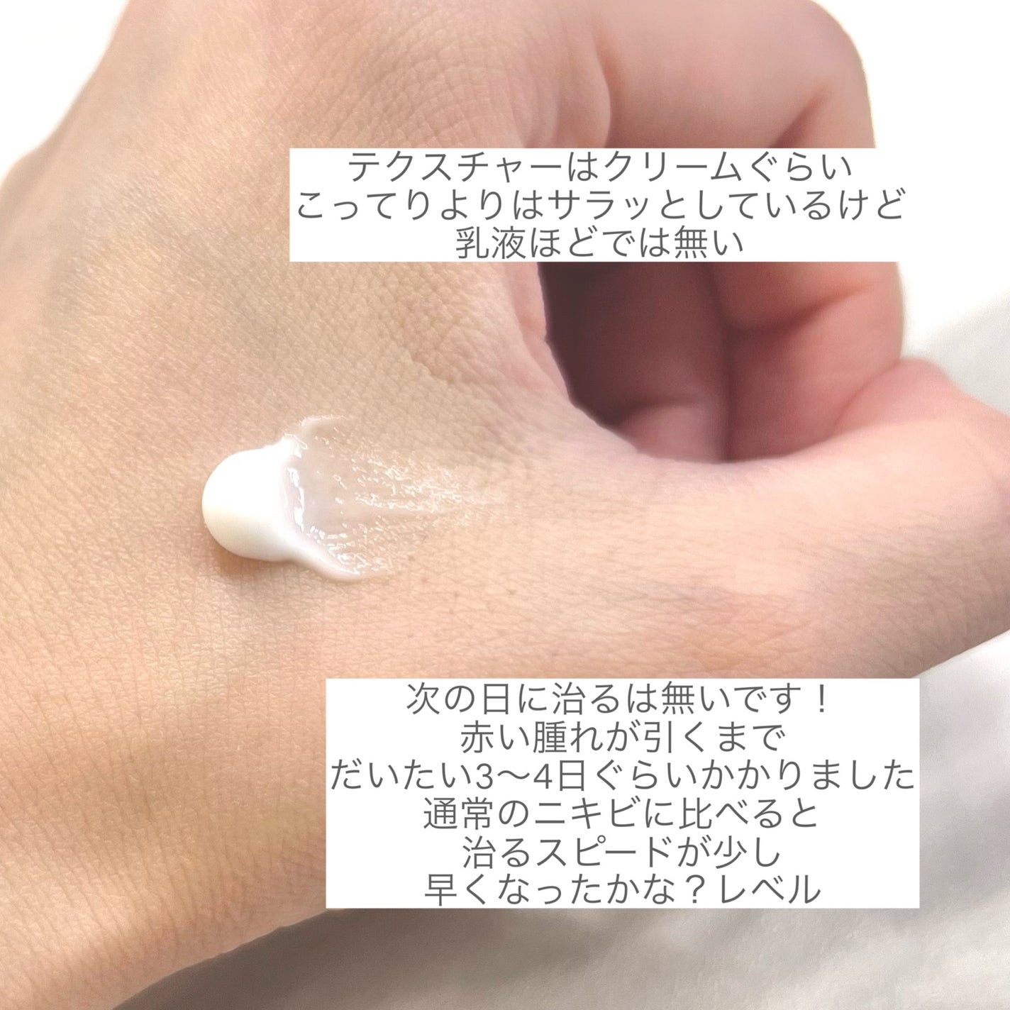 アクネキュアクリーム(医薬品)/IHADA/その他を使ったクチコミ(2枚目)