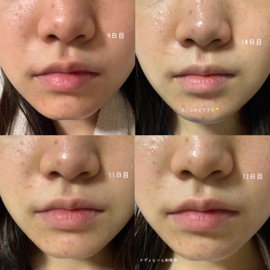 ð°ð· on LIPS ããããæ²æ»
ã®ãã30æ¥éããã¿ãã³Cãšãã¿ãã³Bã飲ã¿ç¶ããæ°Ž..ãïŒ4æç®ïŒ