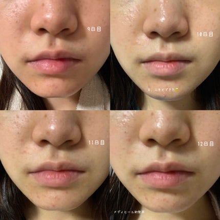 ð°ð· on LIPS ããããæ²æ»
ã®ãã30æ¥éããã¿ãã³Cãšãã¿ãã³Bã飲ã¿ç¶ããæ°Ž..ãïŒ4æç®ïŒ