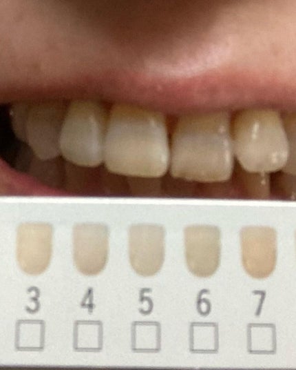 アパガードソフト/アパガード/歯磨き粉を使ったクチコミ(4枚目)