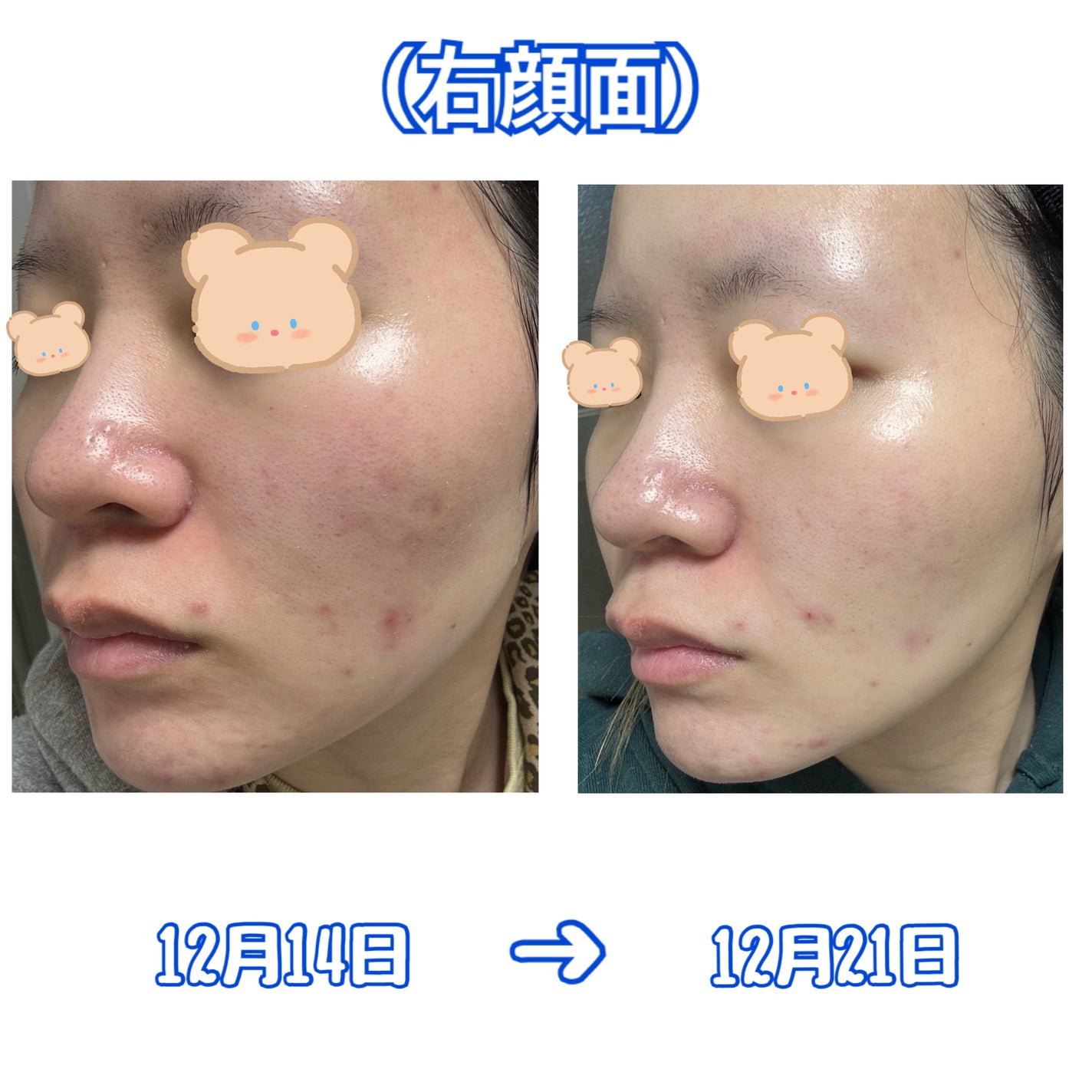 白潤 薬用美白化粧水(しっとりタイプ)/肌ラボ/化粧水を使ったクチコミ(4枚目)