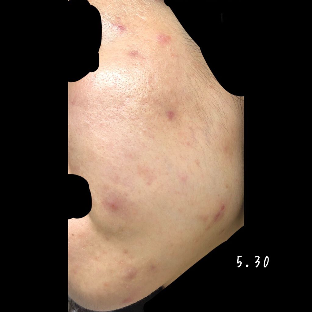 ベジータ on LIPS 「下書き消化! 5.21〜5.30オルビスのニキビケアシリーズ気..」(9枚目)