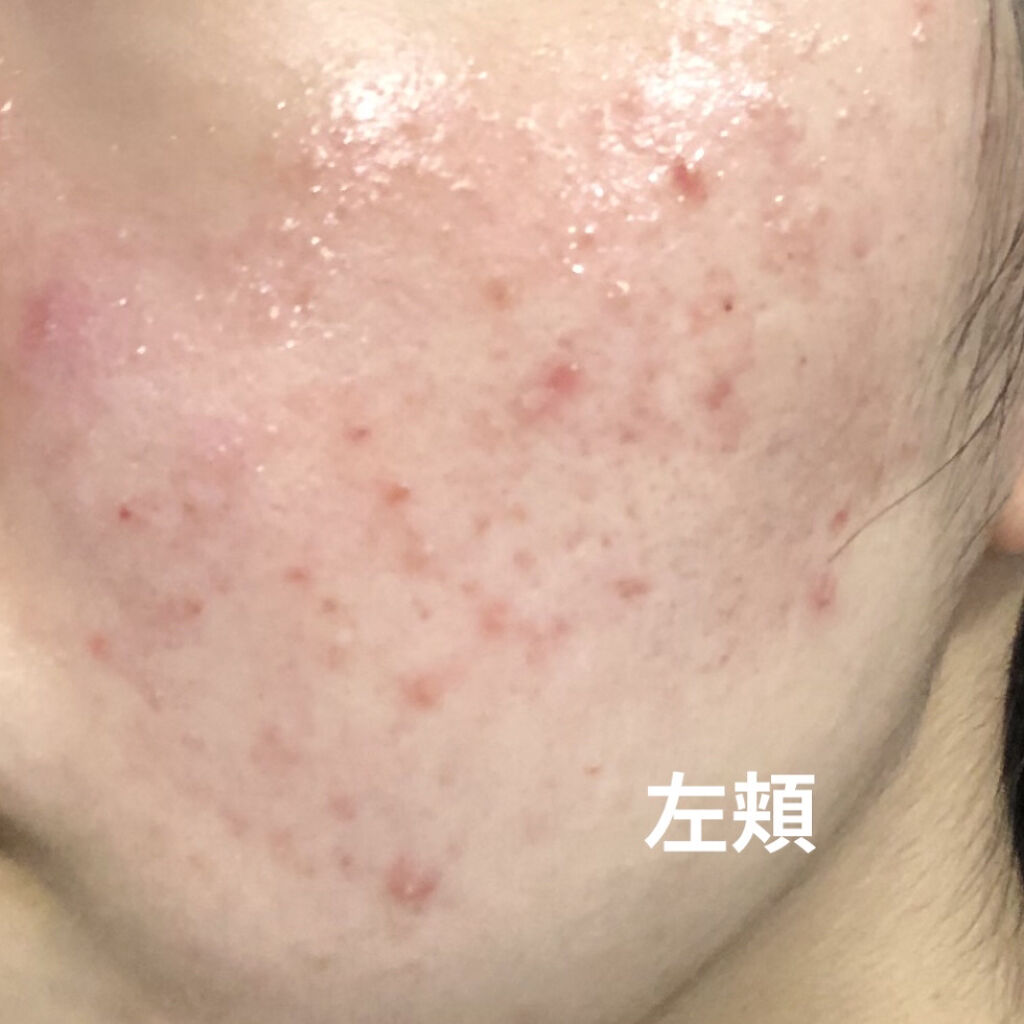 ペアアクネクリームW(医薬品)/ペア/その他を使ったクチコミ（3枚目）