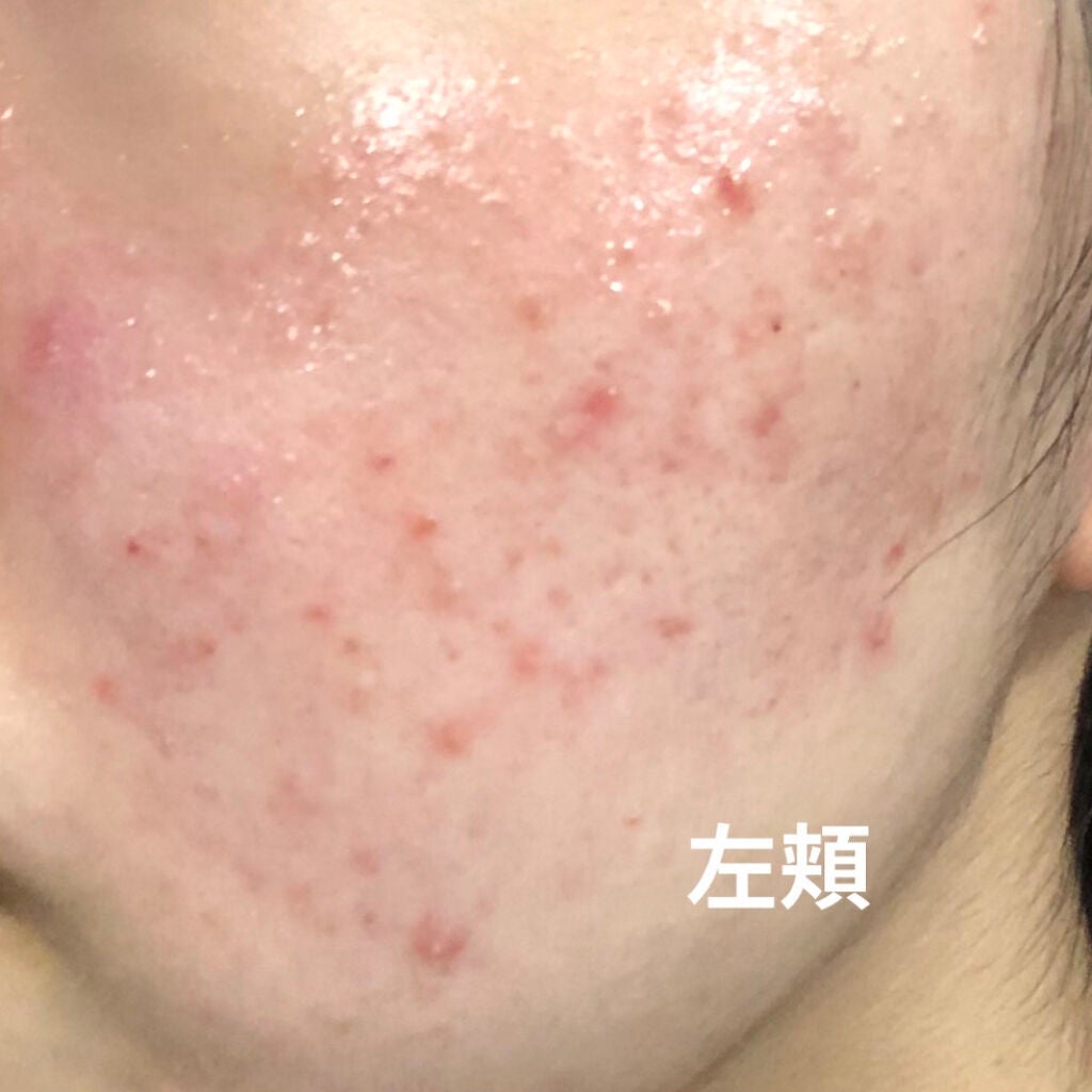 A アクネフォーム/NOV/洗顔フォームを使ったクチコミ(3枚目)