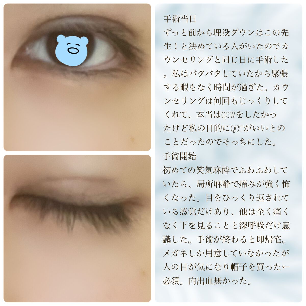 二重整形/その他を使ったクチコミ（3枚目）