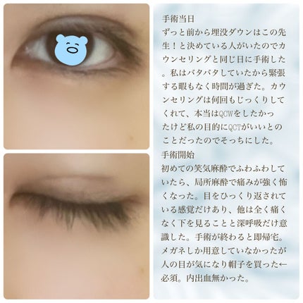 二重整形/その他を使ったクチコミ(3枚目)