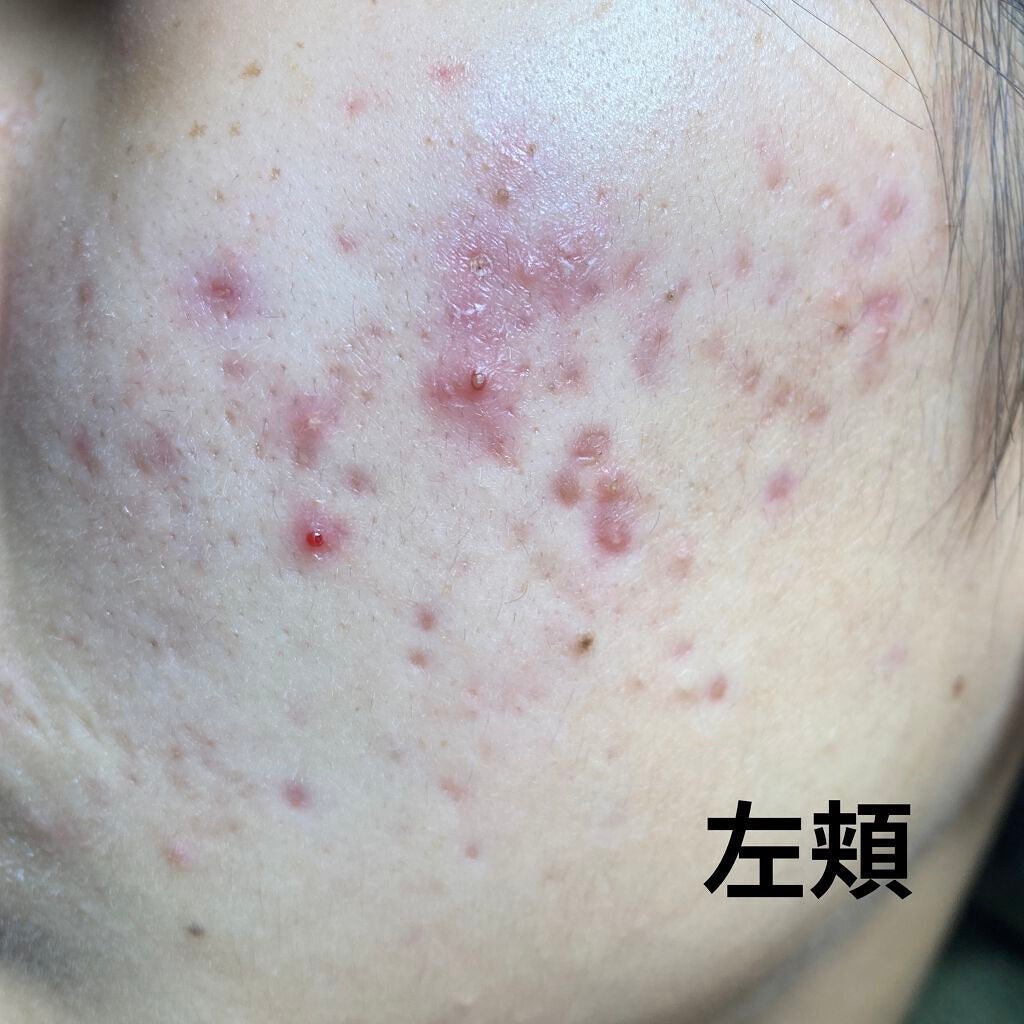 ãªãð± on LIPS ããããã»ãããè·¡ãæ²»ããã髿 ¡çã§ã!!ãã1幎ã§èããã®ãã..ãïŒ2æç®ïŒ