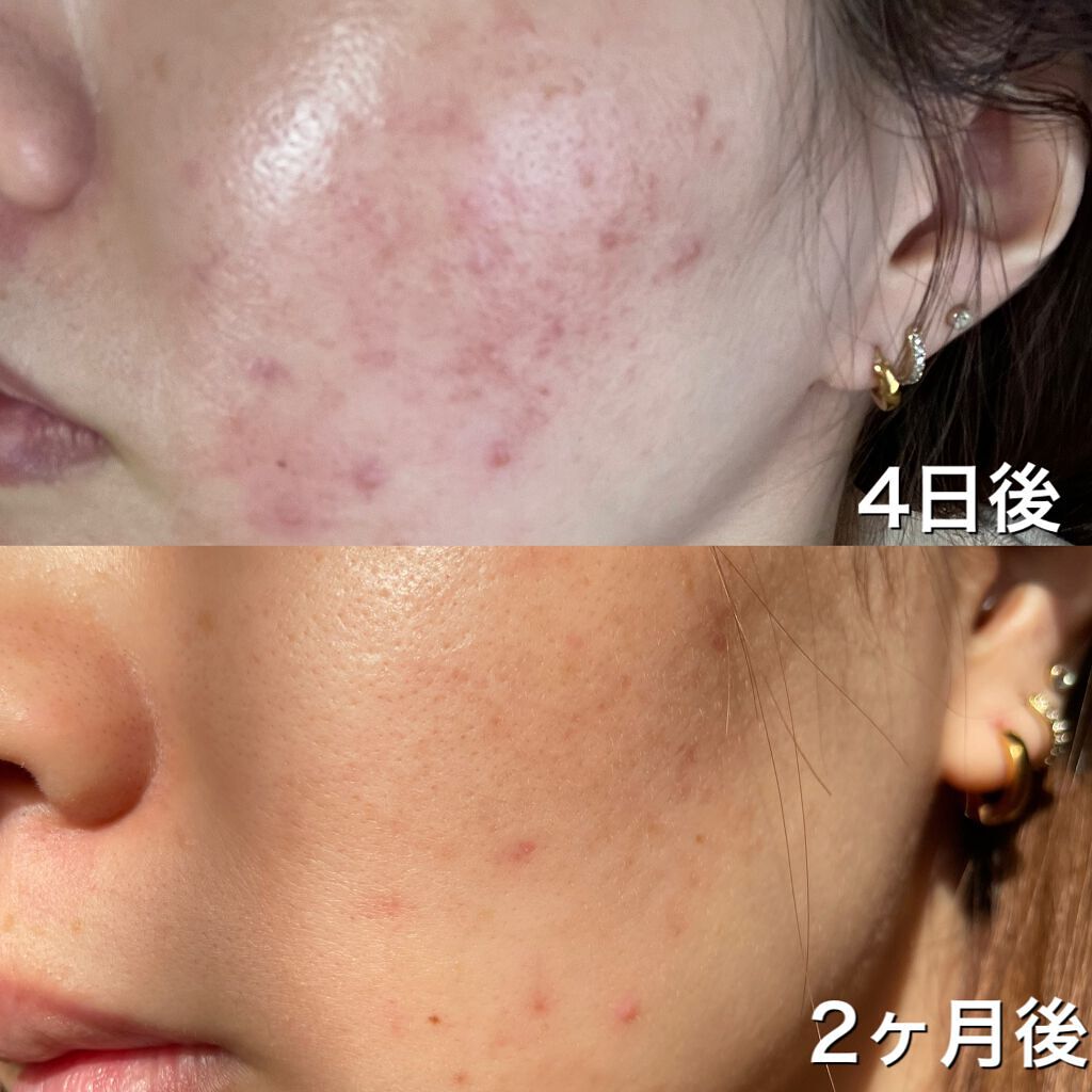 りょう on LIPS 「妊娠中のニキビケアについて🤰妊娠をキッカケにニキビが大量発生⚠..」(3枚目)