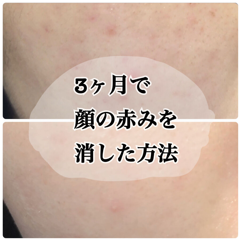 オードムーゲ 薬用ローション（ふきとり化粧水）/オードムーゲ/拭き取り化粧水を使ったクチコミ（1枚目）