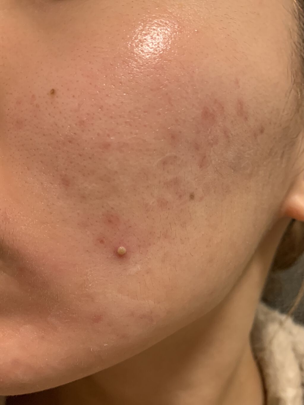 ベピオゲル/マルホ株式会社/その他を使ったクチコミ（1枚目）