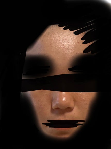 sparkle_rouge_6k96 on LIPS 「助けてください😭このいちご鼻とニキビはどうしたら無くなりますか..」(1枚目)