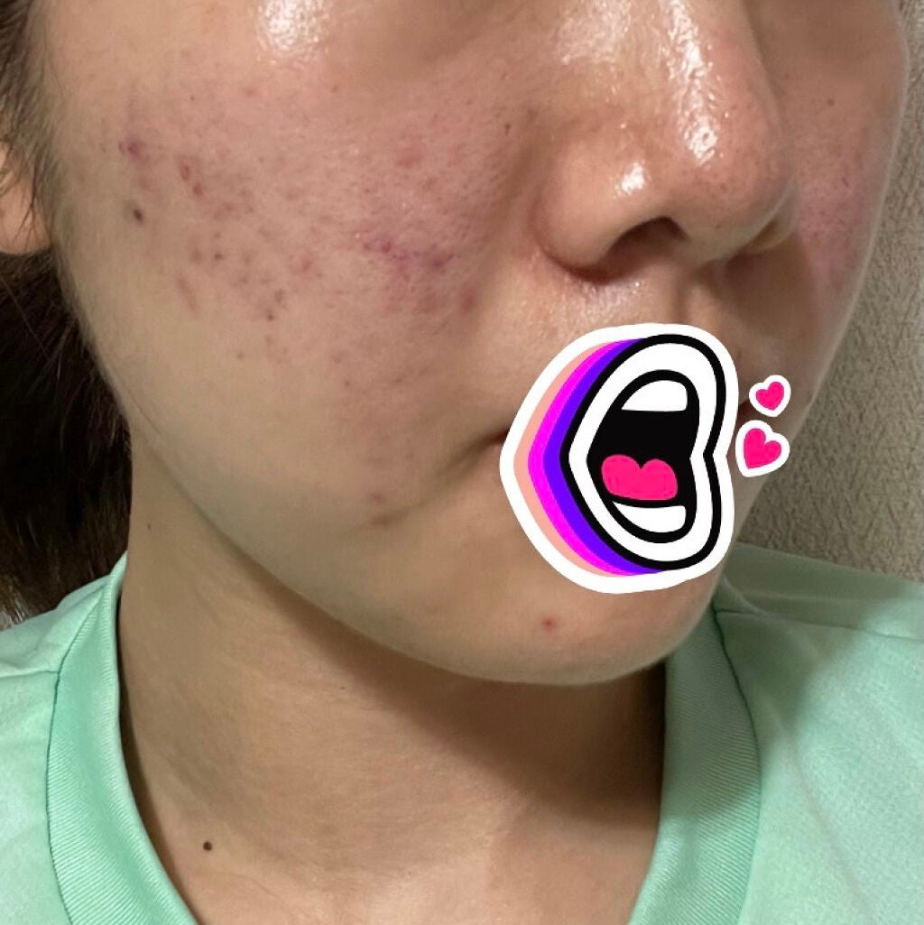 DRX AZAクリア/ロート製薬/その他スキンケアを使ったクチコミ(3枚目)