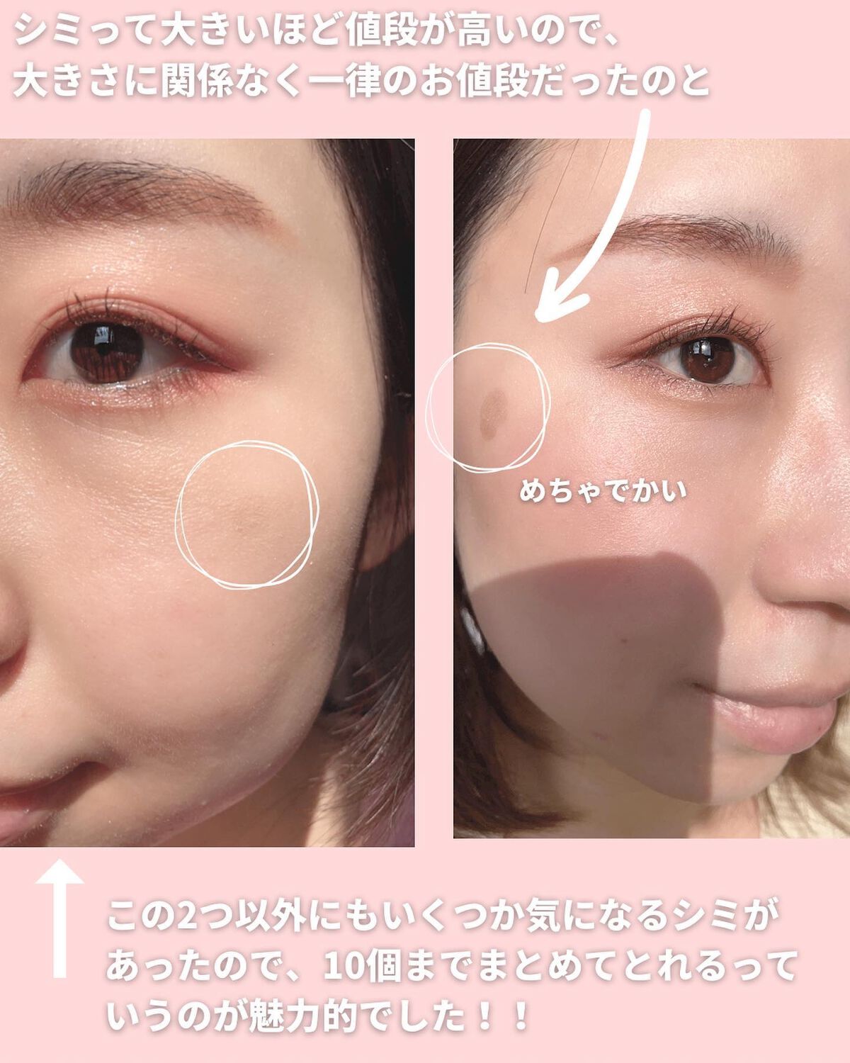 mii♡イエベ春🌸フェミニン on LIPS 「シミとりレーザー感想と経過をまとめました💁🏻♀️✨同じ悩みの..」(4枚目)