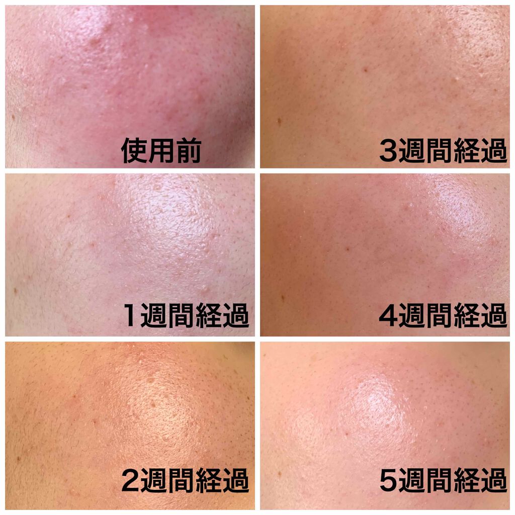 薬用 しみ 集中対策 美容液/メラノCC/美容液を使ったクチコミ(4枚目)