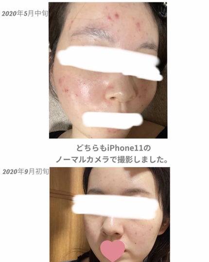 薬用 しみ 集中対策 美容液/メラノCC/美容液を使ったクチコミ(2枚目)