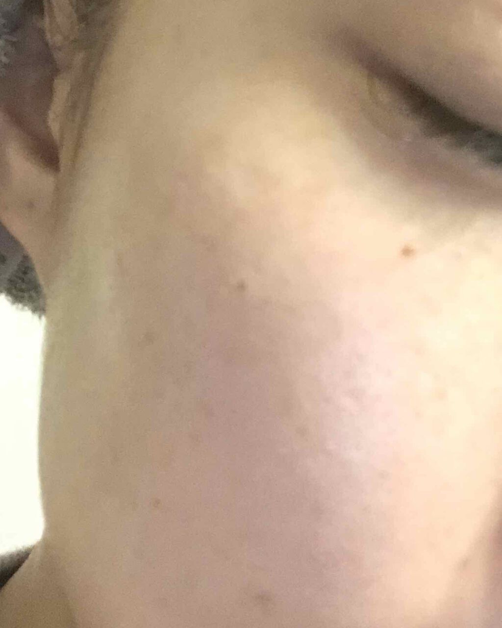 mama28 on LIPS 「#ガチレビュー#しこりニキビ#顎ニキビ#大人ニキビ#ベピオゲル..」(2枚目)