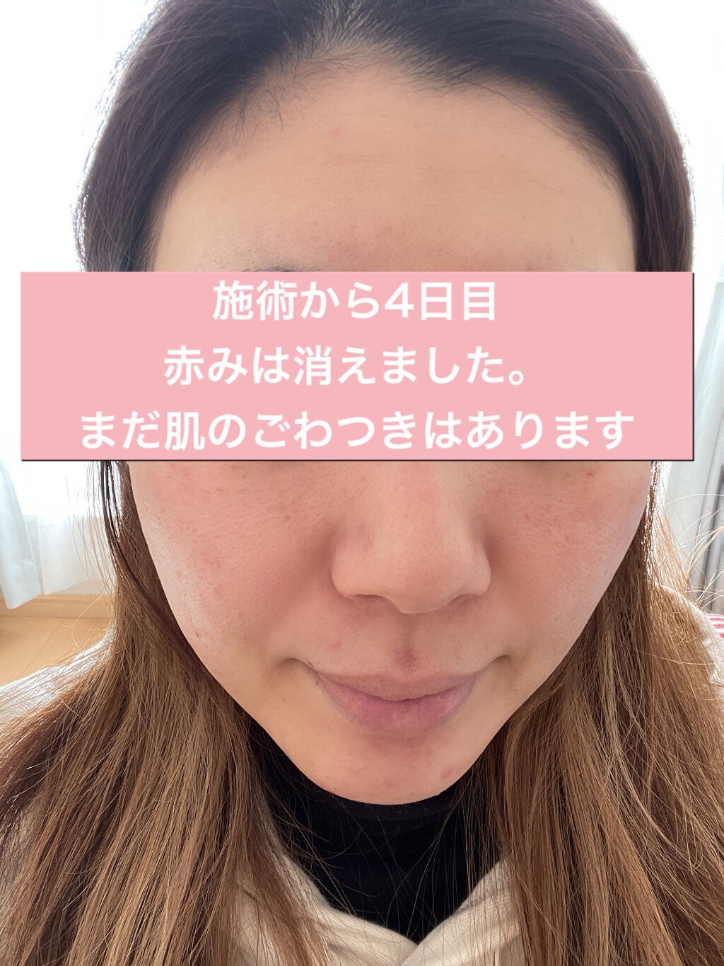 aiko on LIPS 「⚠️写真も真っ赤な肌が出てきます😣しかも写真の撮り方めっちゃ下..」(4枚目)