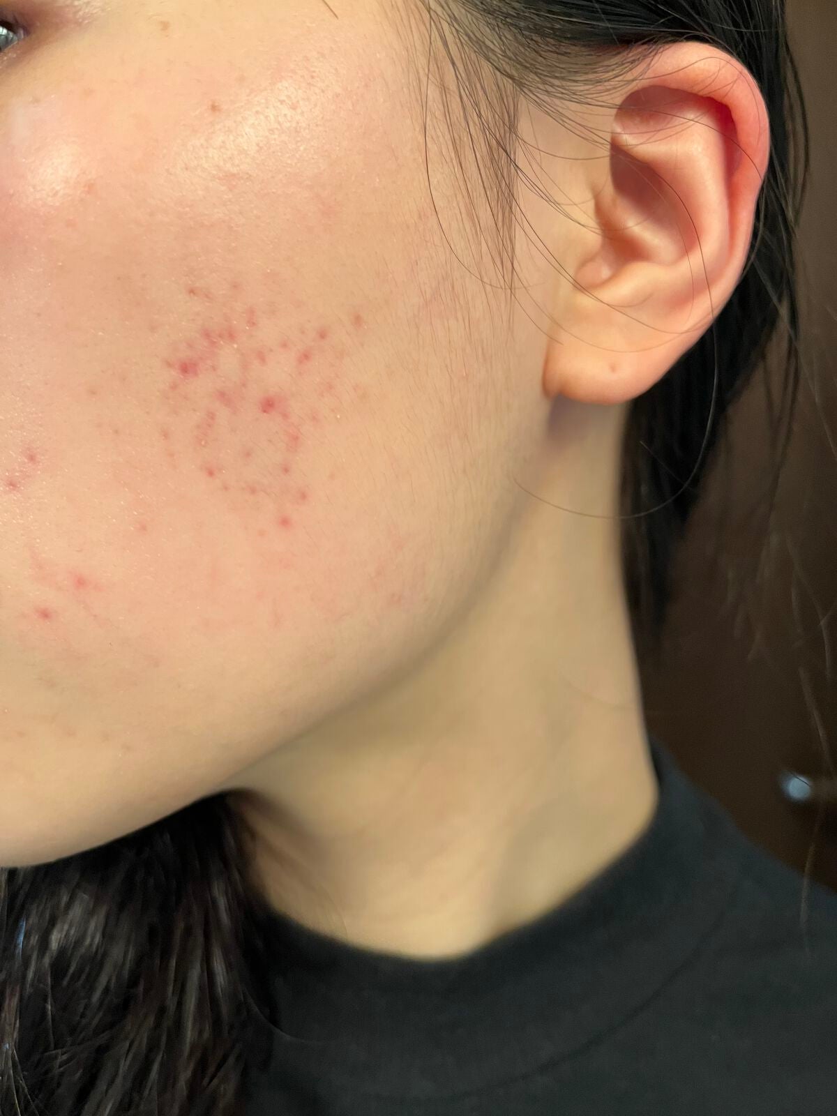 ののの on LIPS 「《ニキビ治療日記Vol.4》約丸3ヶ月が経った状態です。結構綺..」(1枚目)