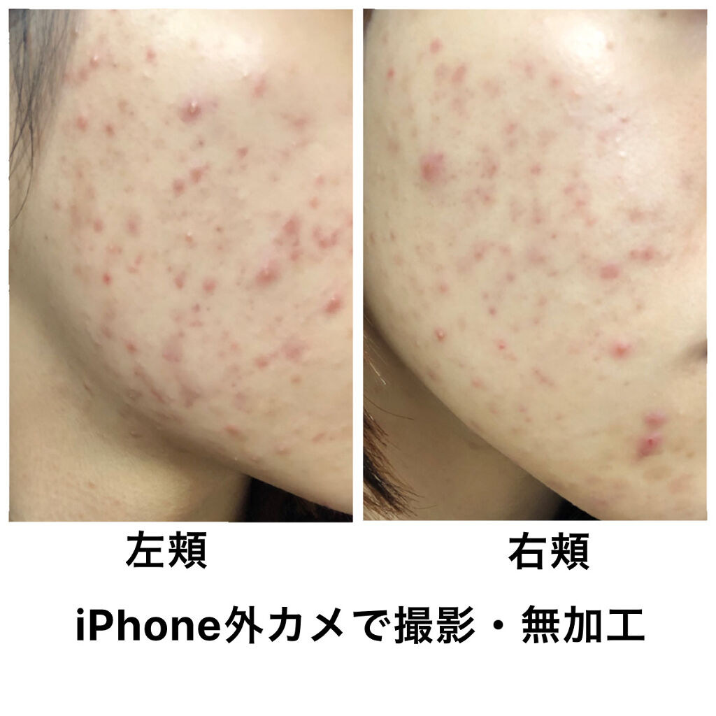 ペアアクネクリームW(医薬品)/ペア/その他を使ったクチコミ（2枚目）