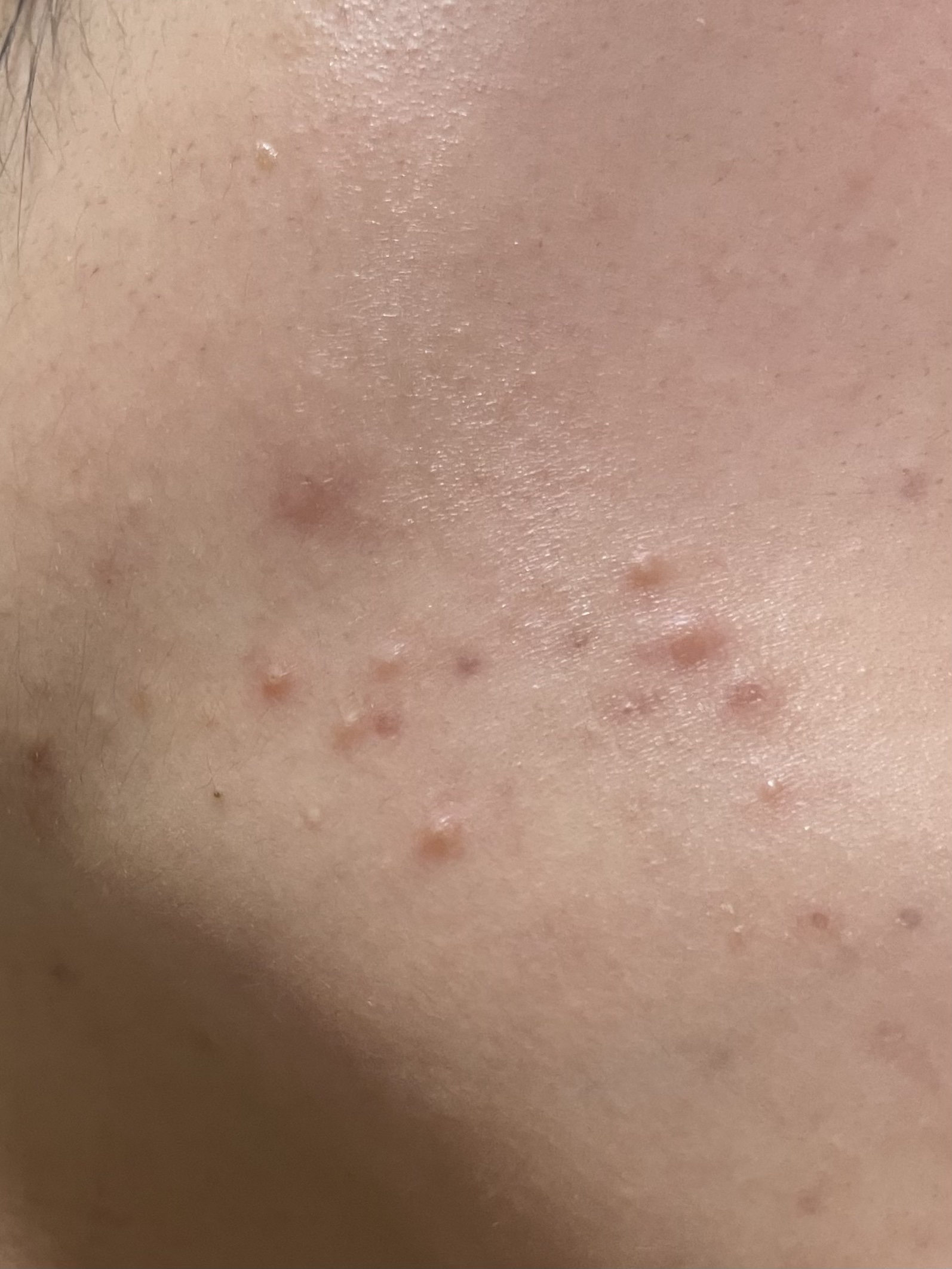 ペアアクネクリームW(医薬品)/ペア/その他を使ったクチコミ（1枚目）