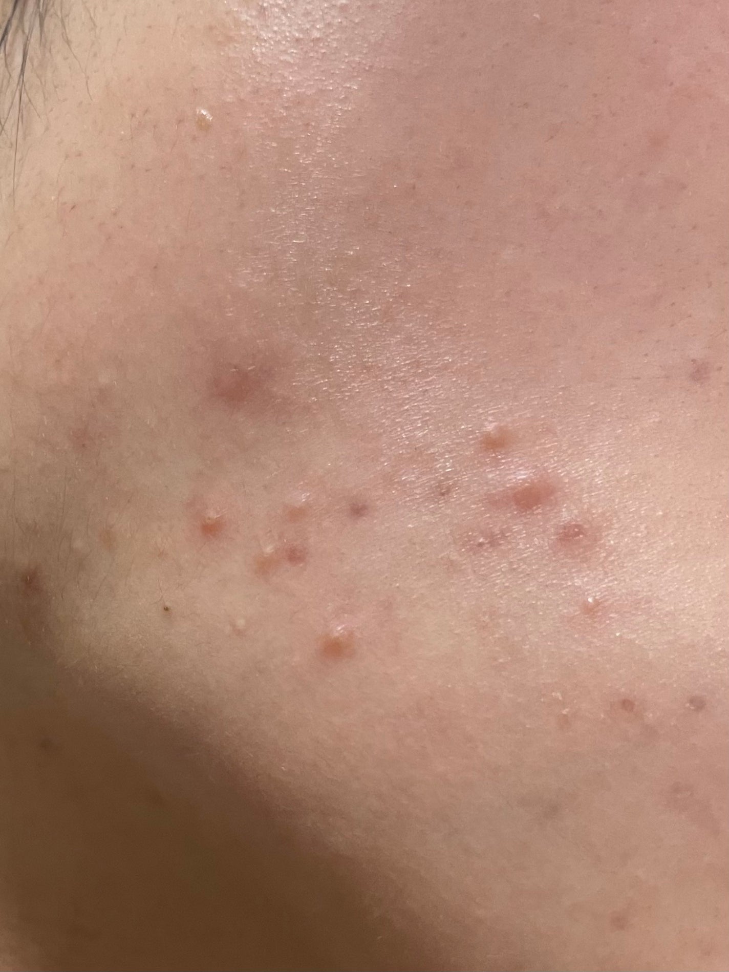 ペアアクネクリームW(医薬品)/ペア/その他を使ったクチコミ(1枚目)