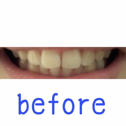 ホワイトニングスポンジ/キャンドゥ/その他オーラルケアを使ったクチコミ(2枚目)