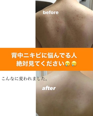 メラノCC 薬用しみ対策 美白化粧水 しっとりタイプのクチコミ「投稿見てくださってありがとうございます！

お見苦しい写真を見せてしまい申し訳
ございません🙇.....」（1枚目）