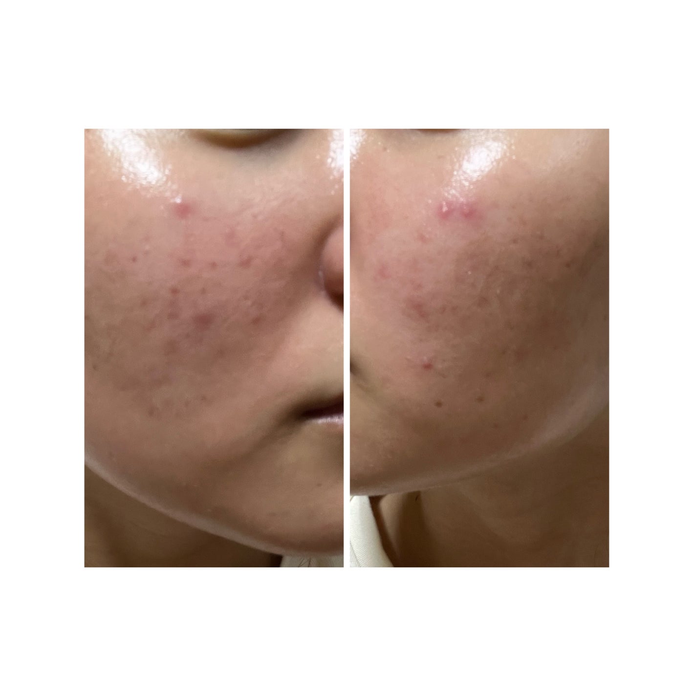 ぽむ on LIPS 「2023.9.13皮膚科に受診 エピデュオとヘパリン処方1枚目..」(2枚目)