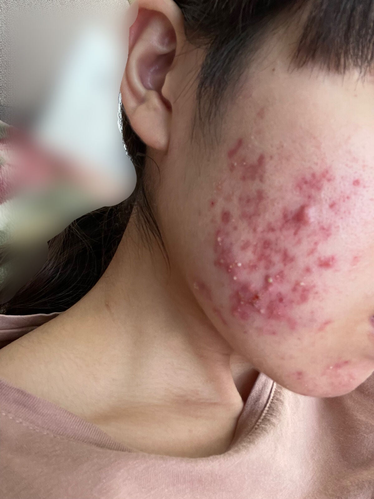 皮脂トラブルケア 保湿ジェル/キュレル/化粧水を使ったクチコミ(2枚目)