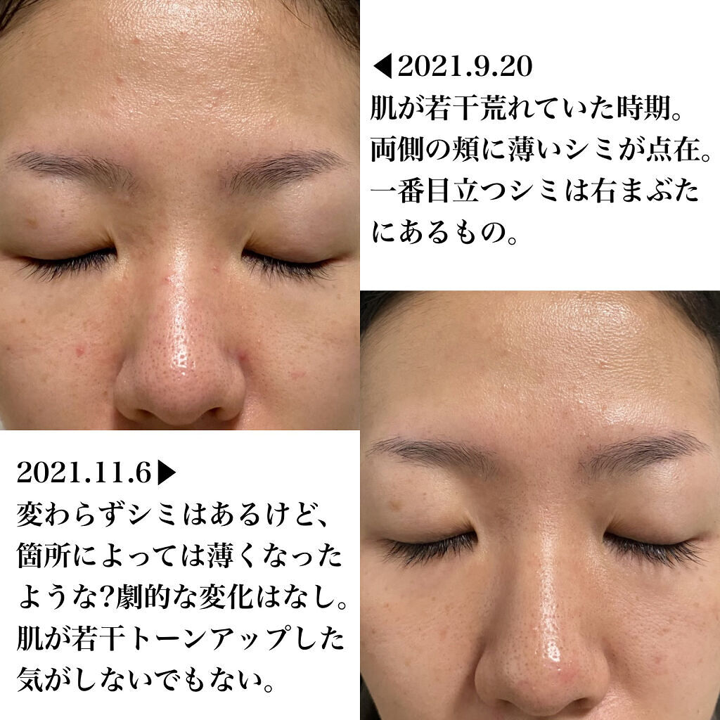 ビタペアC 集中美容液スペシャルセット/ネイチャーリパブリック/美容液を使ったクチコミ（2枚目）