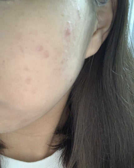 ニキビ治療薬クリーム (医薬品)/クレアラシル/その他を使ったクチコミ(2枚目)