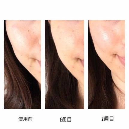 シーバムコントロールVCローションII/プリモディーネ/化粧水を使ったクチコミ(1枚目)