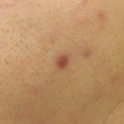 薬用 しみ 集中対策 美容液/メラノCC/美容液を使ったクチコミ(2枚目)