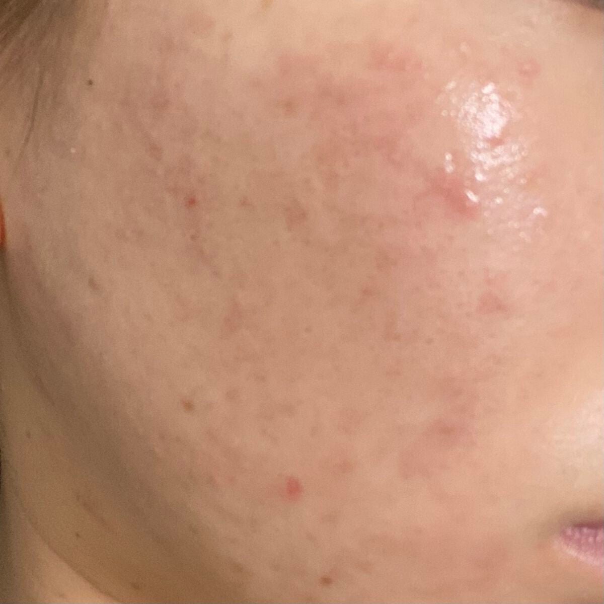 ぺんぎん on LIPS 「⚠️閲覧注意⚠️久しぶりの投稿です!肌の状態としてはずっと停滞..」(1枚目)