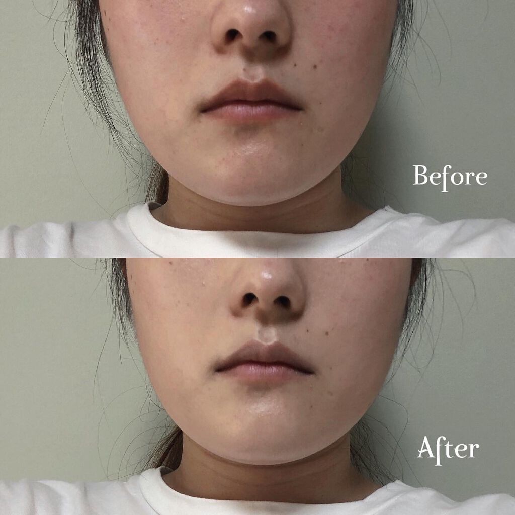 5G リフト ファンデーション/ドクターソワ/クッションファンデーションを使ったクチコミ(4枚目)