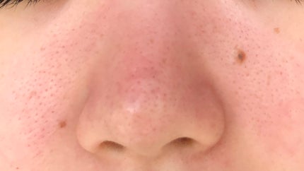 ピンクティーツリートナー/APLIN/化粧水を使ったクチコミ(3枚目)