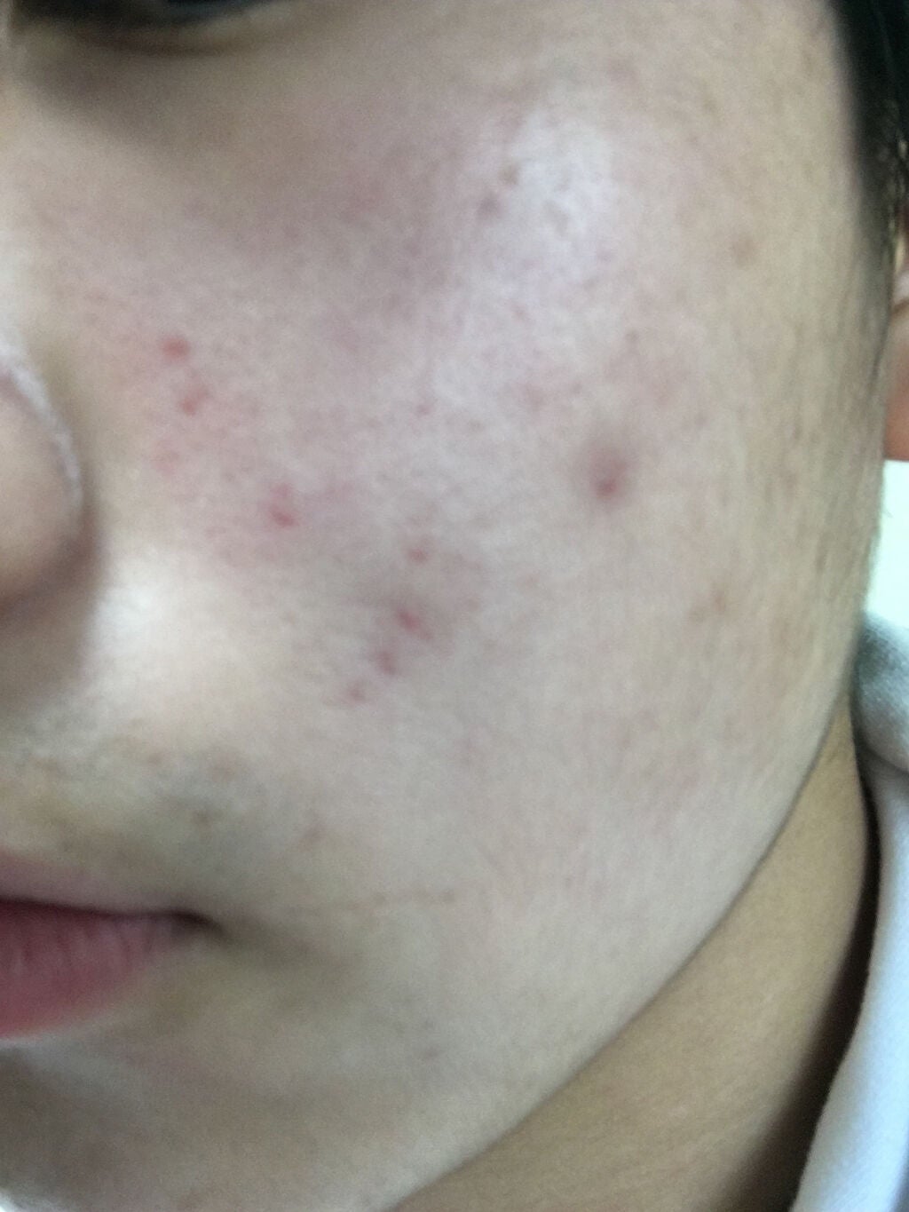 ニキビ悩みの高校一年生男子 on LIPS 「いきなりすいません、汚い肌を見せてしまい。🙇⋱ですが、本気で悩..」(3枚目)