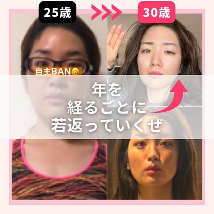 おゆみ|ニキビ・ニキビ跡ケア on LIPS 「@______ohyoume他の投稿はこちらあら【ニキビ治すた..」(7枚目)