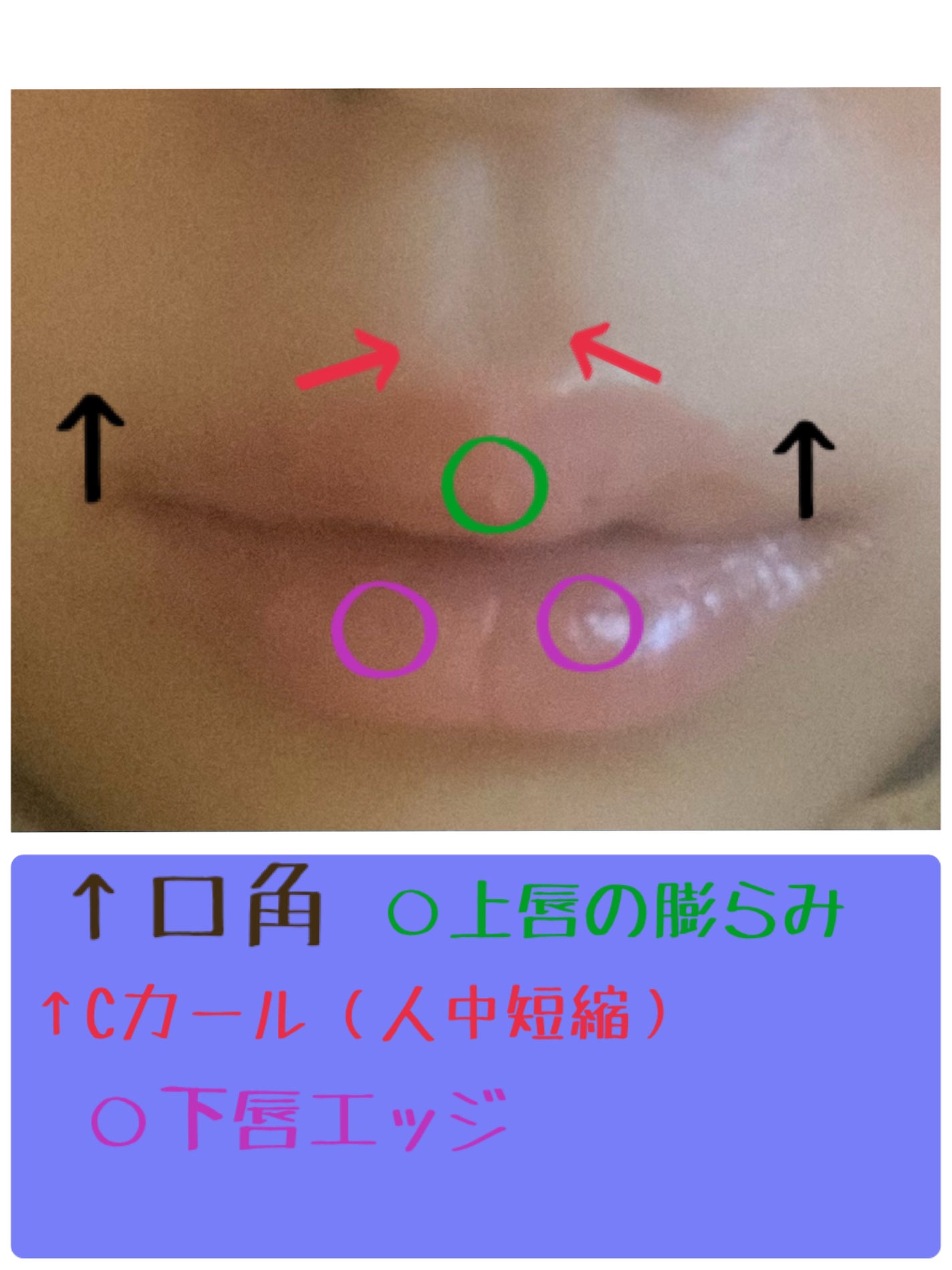 ゆめぽん🍡フォロバ100 on LIPS 「⭐️唇ヒアルロン酸レポ本日唇ヒアルをしました❣️笑気麻酔(オプ..」(2枚目)