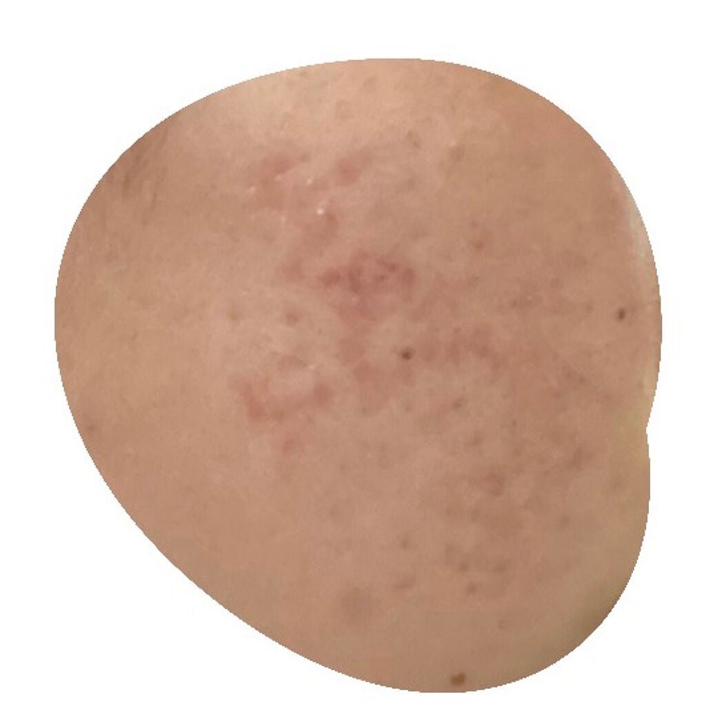 pink_sounds_dlm on LIPS 「ニキビ跡が消える方法教えてください💦..」(1枚目)